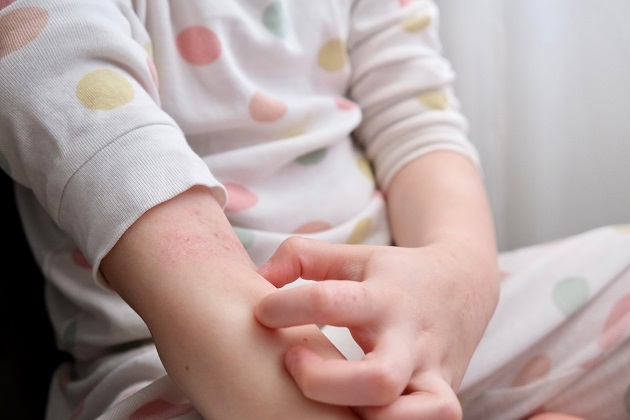 日常的に接するものがアレルギーの原因に？「接触皮膚炎」とは